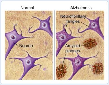Cognitive status and amyloid accumulation in Alzheimer's disease are associated with T cell exhaustion